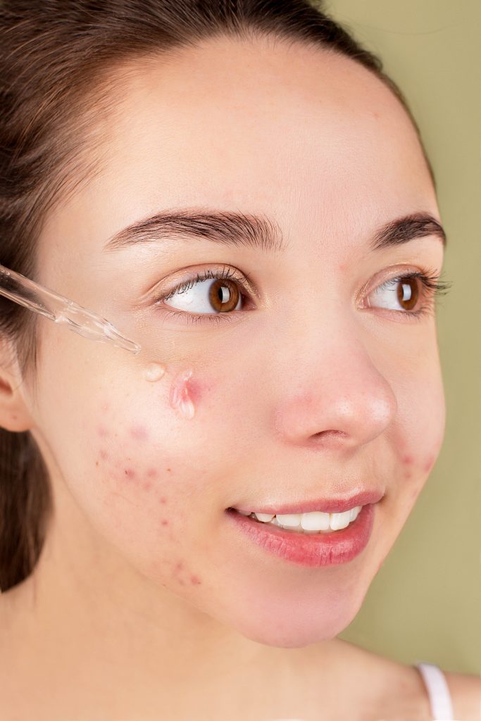 PCOS skincare hacks for acne

